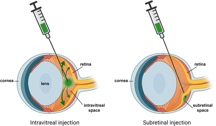 Intravitreal vs. Subretinal injection