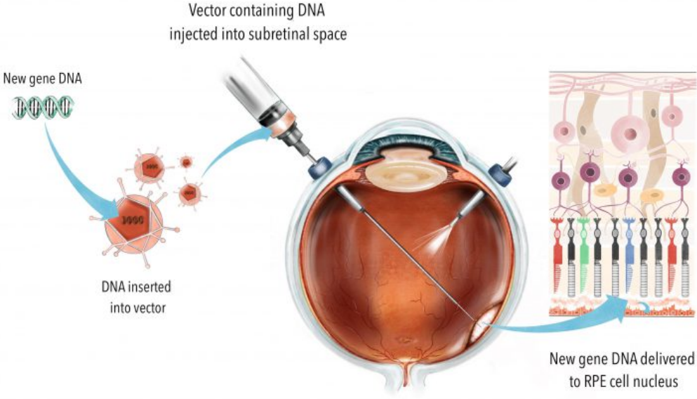 Subretinal gene therapy delivery